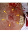 Apósito torácico ventilado para heridas abiertas H-Vent (2 unid.)